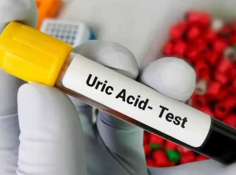 High Uric Acid Tips